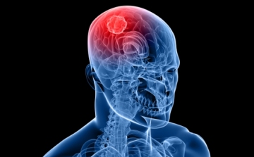 Gyulladáscsökkentéssel enyhíthetők a stroke hatásai magyar kutatók szerint